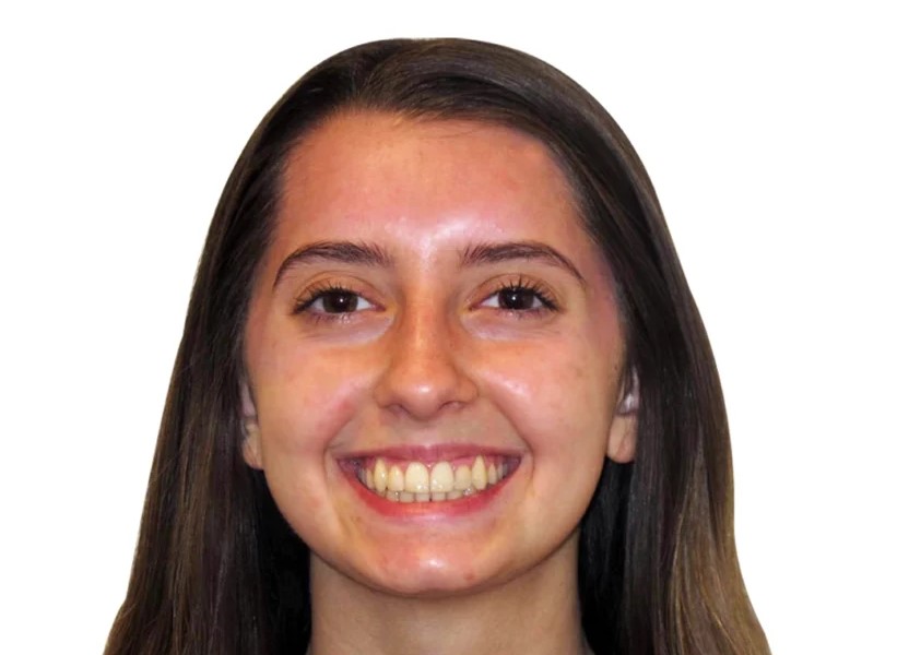 Patient 1 smile after treatment