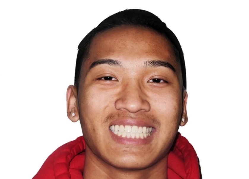 Patient 2 smile after treatment