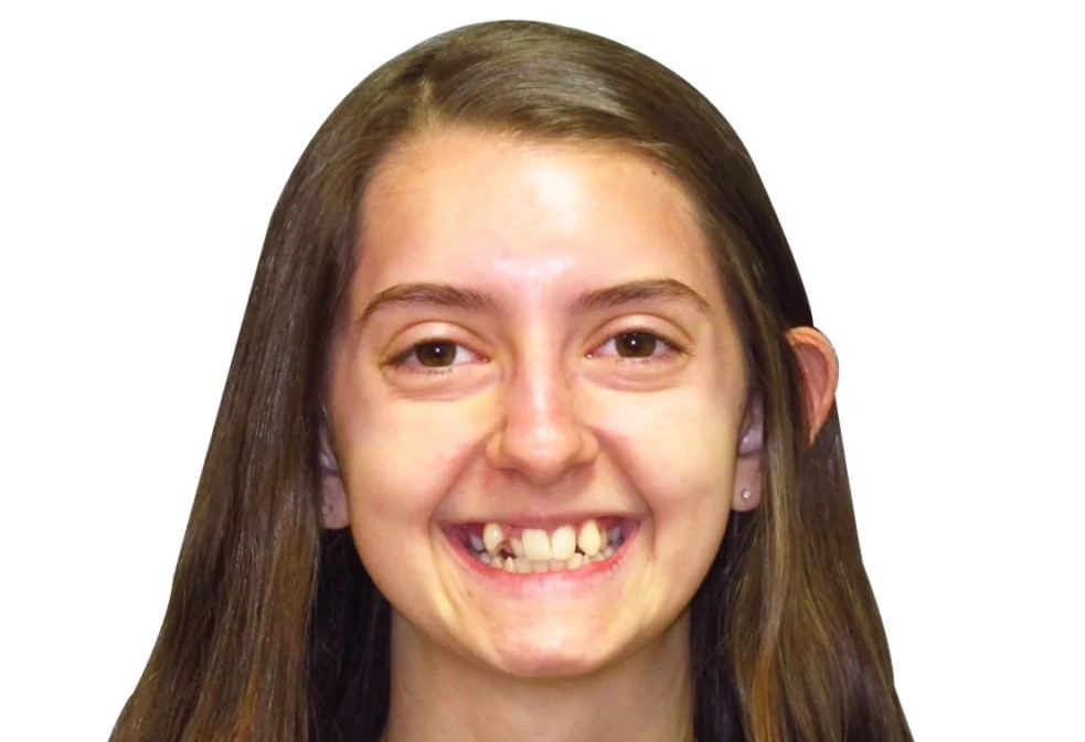 Patient 1 smile before treatment
