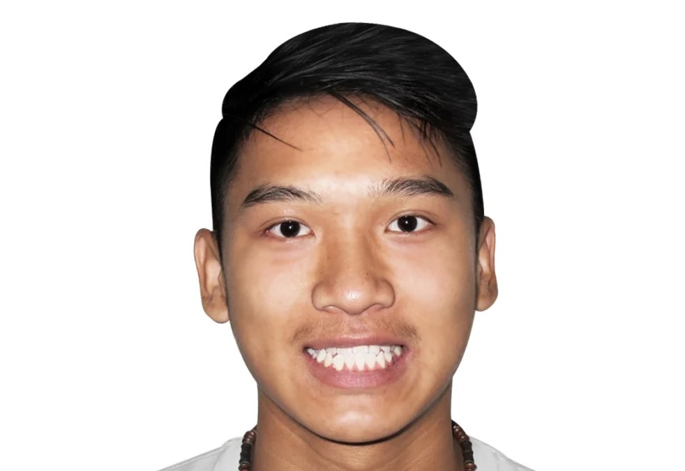 Patient 2 smile before treatment